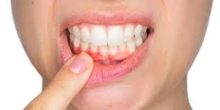  Gyulladt az ínyem. Mi lehet az oka, és mit tegyek?